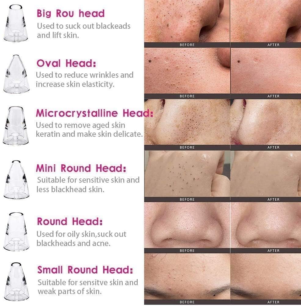 PoreExtract Pro | Multifunction Blackhead Remover Vacuum | 3-Speed Adjustable Mode Format | 6 Interchangeable Suction Heads